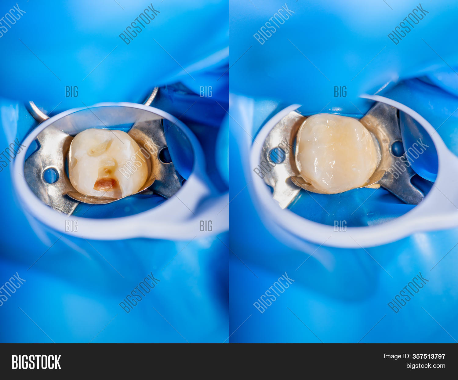 Dental Caries. Filling Image & Photo (Free Trial) Bigstock