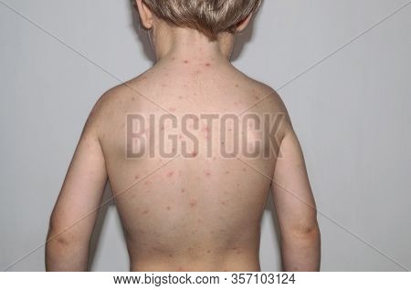 Chickenpox Disease. Boy Sick On His Back . Chickenpox Virus, Chicken Pox Outbreak In Children. Conce