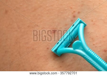 Close Up Picture Of Woman Holding Razor, Shaving Her Hairy Leg With Folliculitis