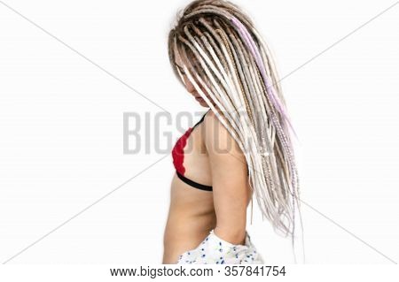 Girl With Bad Skin Acne And Black Red Festering Pimples  On The Face And Body