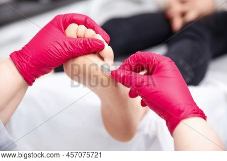 Podiatrist Treating Toenail Fungus. Podology Foot Treatment.