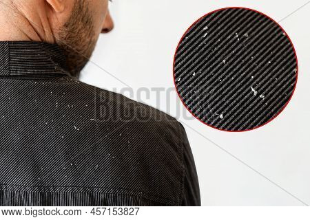 A Bearded Man In A Black Shirt, A Close Up View Of The Shoulder Covered With Dandruff. White Backgro