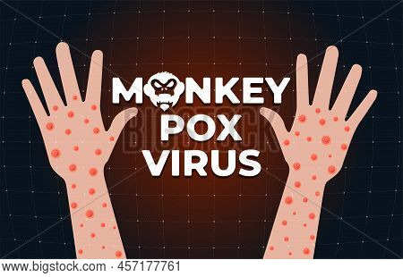 Monkeypox Virus Infection On Hand Banner Concept. Monkey Pox Disease Outbreak Blisters And Rash On A