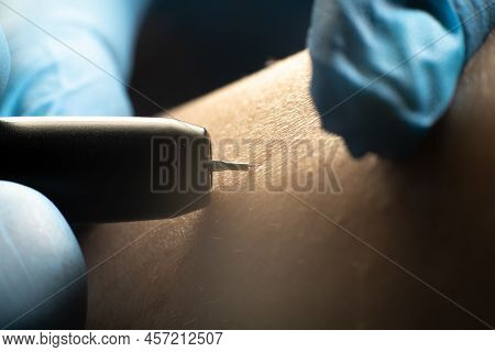 Process Of Permanent Unwanted Hair Removal, Using An Electroepilation Device, Close Up Macro Photo