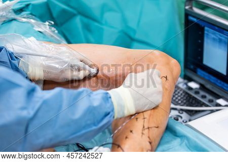 Varicose Veins Surgery Act, Superficial Veins Problems, Swollen Skin