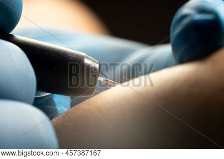 Process Of Permanent Unwanted Hair Removal, Using An Electroepilation Device, Close Up Macro Photo
