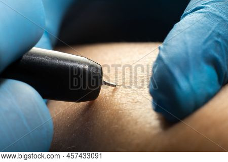 Close Up The Process Of Permanent Hair Removal, Using An Electroepilation Device.