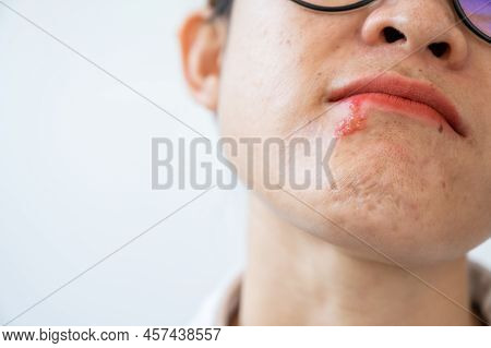 Herpes Labialis Of The Woman Lower Lip With Isolated Copy Space. Blisters That Break Open And Form S