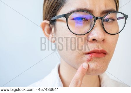 Asian Woman Pointing To Herpes Labialis Occur On Her Lower Lip. Blisters That Break Open And Form Sm