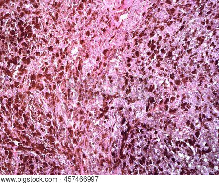 Human Lymph Node. Metastasis Of A Malignant Melanoma. The Normal Lymphoid Tissue Of Lymph Node Has C
