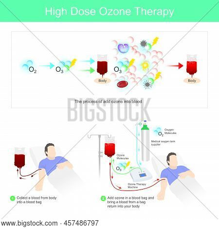 High Dose Ozone Therapy. This Process Add Ozone In A Blood Bag And Bring A Blood From A Bag Return I
