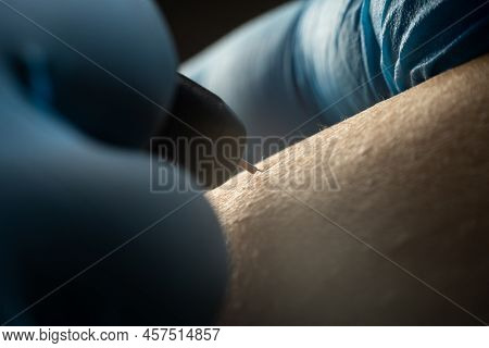 Process Of Permanent Hair Removal, Removing Unwanted Hair Using An Electroepilation Device