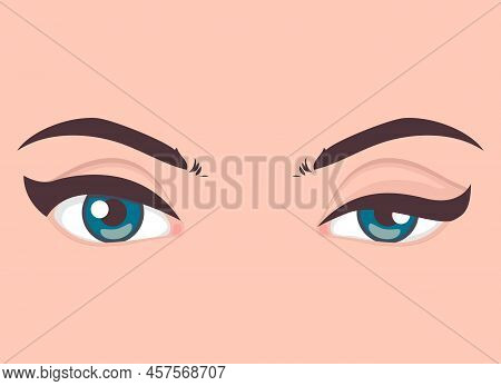 Ptosis Of The Upper Eyelid, Optical Problem With Eye, Medical Vector Illustration