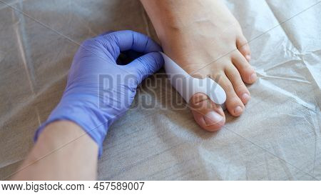 Top View Of Doctor Orthopedist Applying Brace For Hallux Valgus. Deformity Of Joints Of Foot And Hea