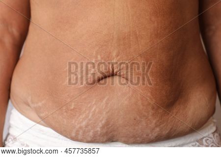 Close Up Of Woman's Belly With Stretch Mark Loose Lower Abdomen Skin She Fat After Pregnancy Baby Bi
