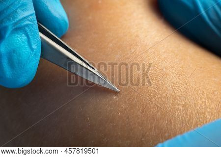 Process Of Permanent Hair Removal, Removing Unwanted Hair Using An Tweezers, Close-up Macro Photogra