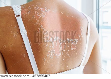 Consequences Of Sunburn, Cracked Skin Of Back Will Peel Off In Layers. Back Of Woman With Straps Of 