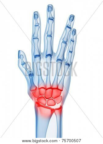 arthritis