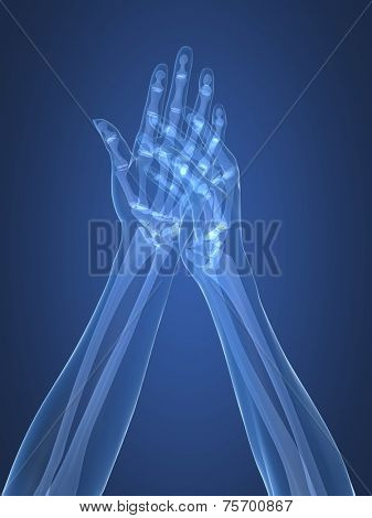 x-ray hands - arthritis