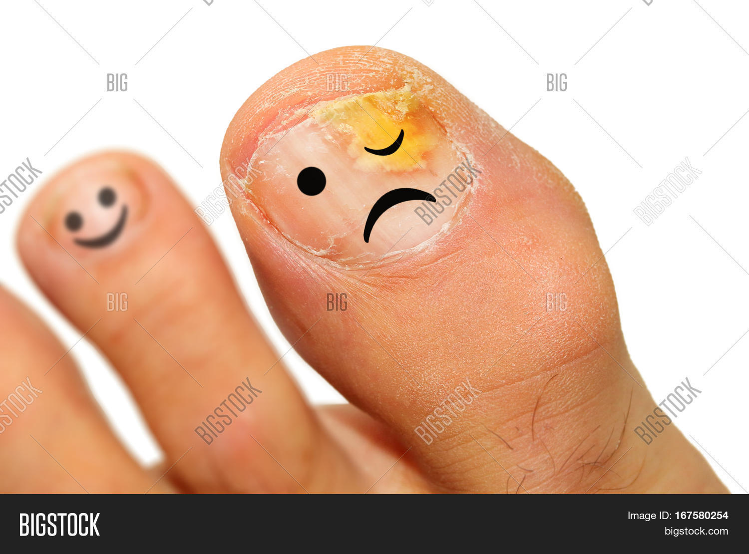 Onychomycosis Fungal Image & Photo (Free Trial) Bigstock