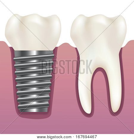 Realistic Human Tooth and Dental Implant Stomatology Health Care Concept. Vector illustration