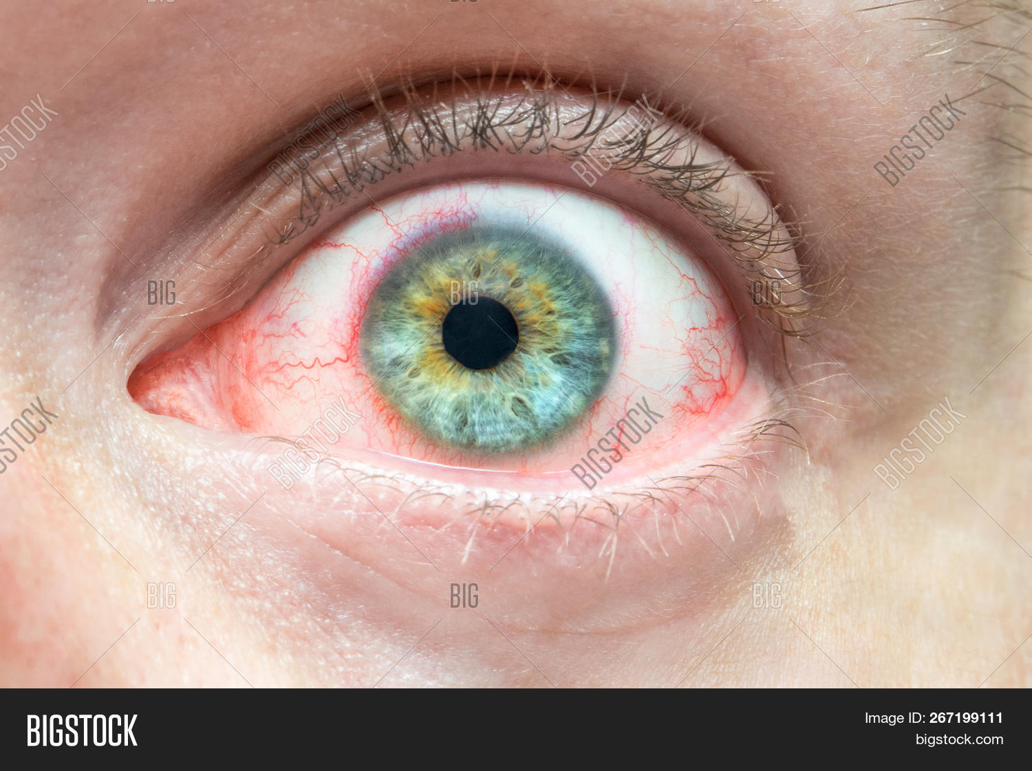 Mens Irritated Red Eye Image & Photo (Free Trial) Bigstock