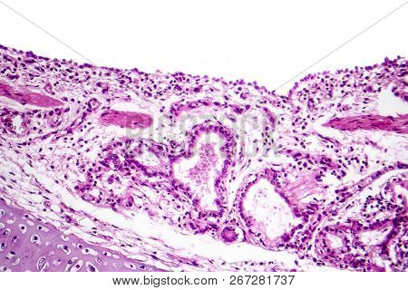 Histopathology Of Bronchopneumonia, Light Micrograph, Photo Under Microscope