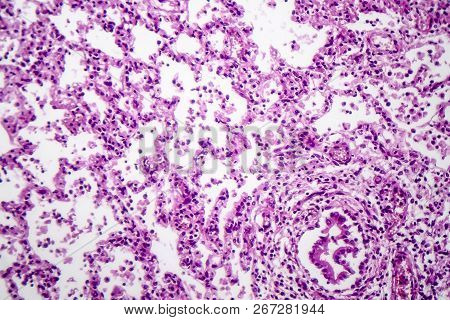 Histopathology Of Bronchopneumonia, Light Micrograph, Photo Under Microscope