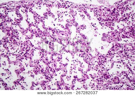 Histopathology Of Bronchopneumonia, Light Micrograph, Photo Under Microscope