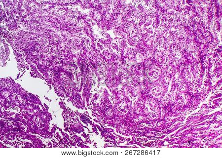 Histopathology Of Lung Cancer, Light Micrograph, Photo Under Microscope