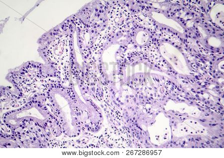 Histopathology Of Nasal Polyps, Light Micrograph, Photo Under Microscope