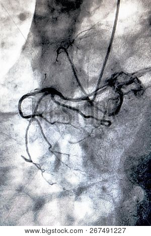 Catheterization. Cardiac Ventriculography Is A Medical Imaging Test Used To Determine A Patient Card