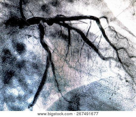Catheterization. Cardiac Ventriculography Is A Medical Imaging Test Used To Determine A Patient Card