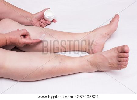 Elderly Woman Applies Healing Ointment On Legs With Thrombosis And Varicose Veins, White Background,