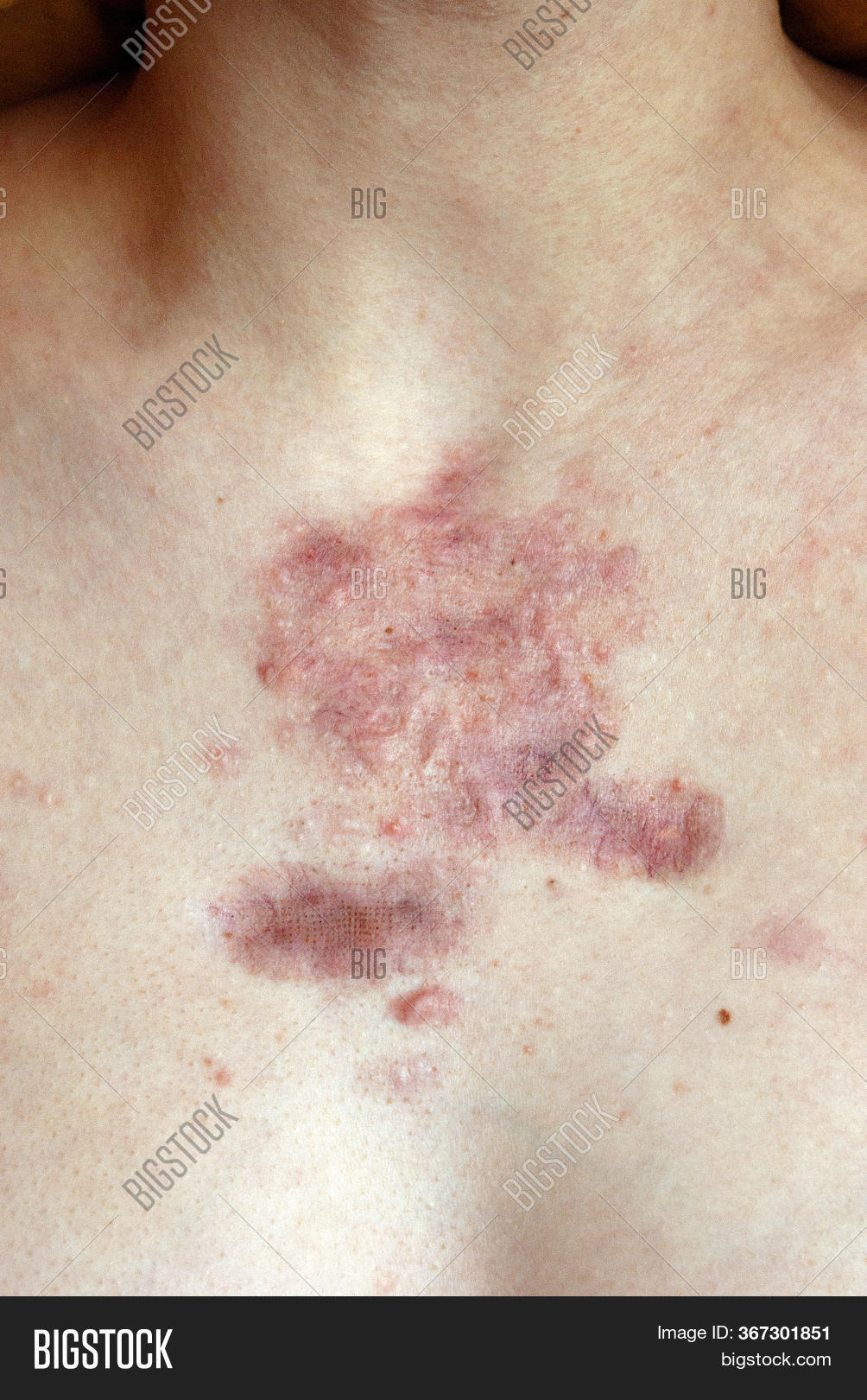 Keloid Hypertrophic Image & Photo (Free Trial) Bigstock