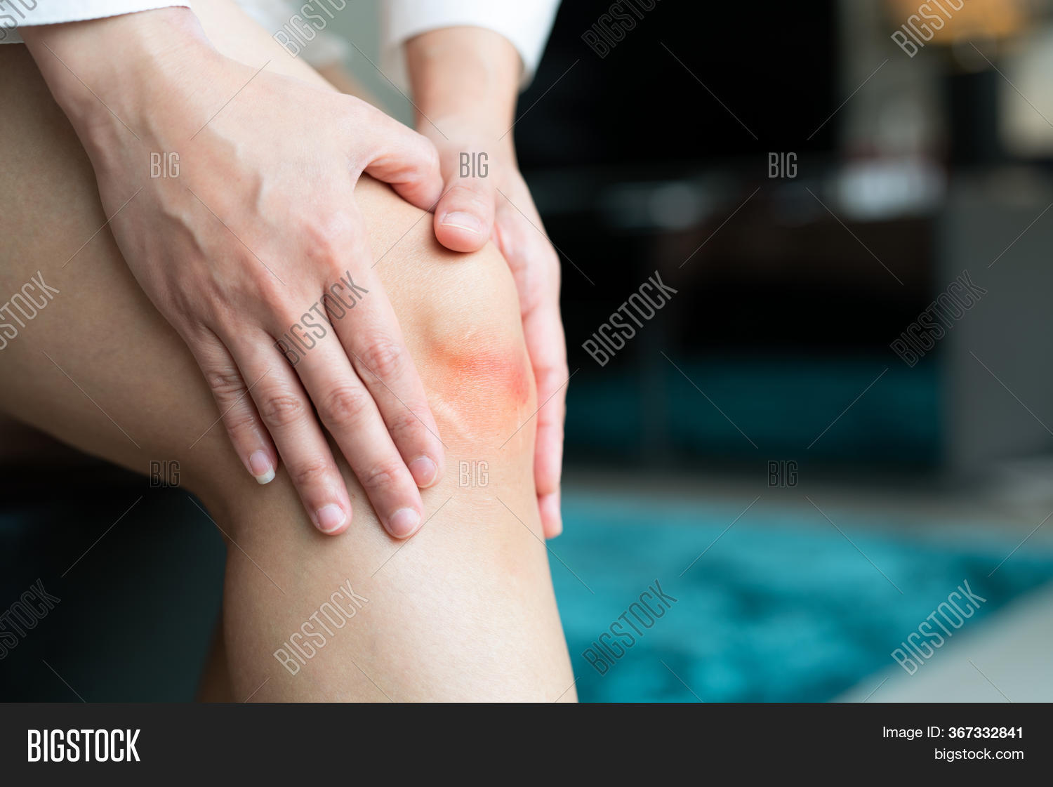 Bruised Knee Asia Image & Photo (Free Trial) Bigstock