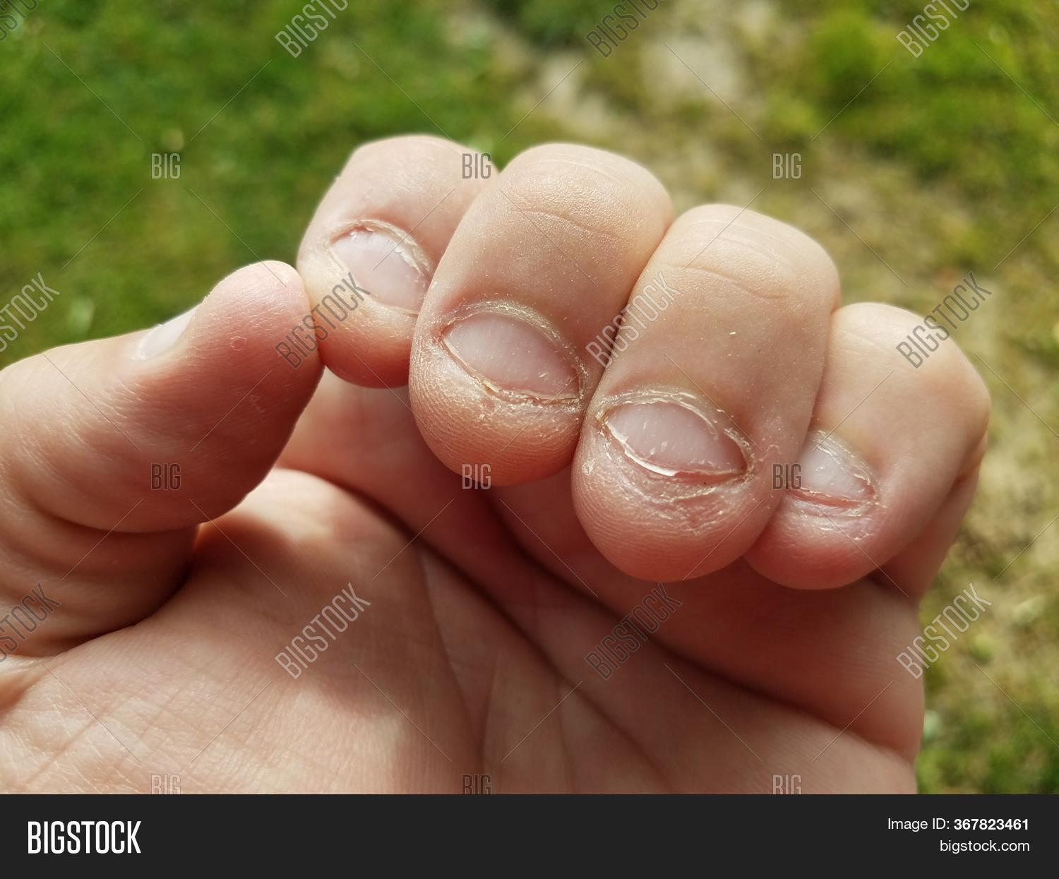 Bitten Nasty Unhealthy Image & Photo (Free Trial) Bigstock