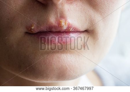 Herpes Disease On The Lips Of A Young Girl. Wounds From Herpes On The Lips Of A Person. Herpes Foci.