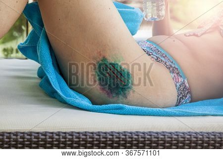 Hematoma, Microtrauma, Soft Tissue Injury, Deep Scratches, Cuts On The Girl's Thigh, Treated With A 