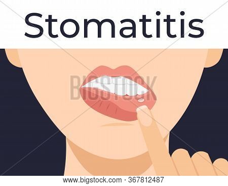 Stomatitis. Woman Has Inflammation Of The Mouth And Lips. Flat Vector Cartoon Modern Illustration.