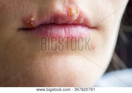 Herpes Disease On The Lips Of A Young Girl. Wounds From Herpes On The Lips Of A Person. Herpes Foci.