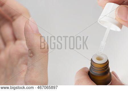 Cure For Warts. Bottle With Medicine For The Treatment Of Warts In The Hands Of A Woman Close-up. Tr