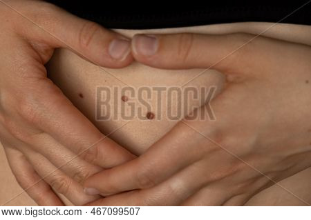Unrecognizable Woman Showing Her Birthmarks On Skin Close Up Detail Of The Bare Skin Sun Exposure Ef