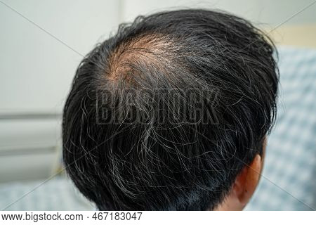 Bald In The Middle Head And Begin No Loss Hair Glabrous Of Mature Asian Business Smart Active Office