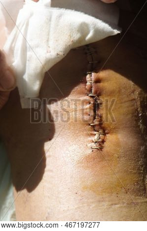 Surgical Suture On The Knee. Surgical Wound Sutured With Special Metal Suture For Healing. Total Kne