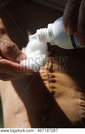 Surgical Suture On The Knee. Surgical Wound Sutured With Special Metal Suture For Healing. Total Kne