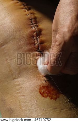 Surgical Suture On The Knee. Surgical Wound Sutured With Special Metal Suture For Healing. Total Kne