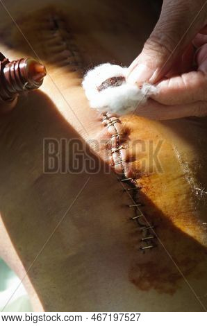 Surgical Suture On The Knee. Surgical Wound Sutured With Special Metal Suture For Healing. Total Kne