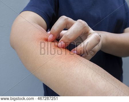Clopped Image Of Woman Are Itching And Scratching Of Skin Diseases. Concept With Healthcare And Medi
