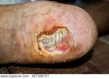Diabetes Foot Ulcer In Foot Of Asian Patient. Closeup View.
